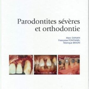 Parodontites Sévères et Orthodontie
