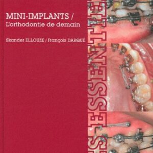 Mini-implants L'orthodontie de demain