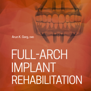 Full-Arch Implant Rehabilitation