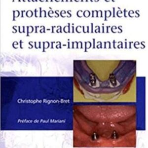 Attachements et prothèses complètes supra-radiculaires et supra-implantaires